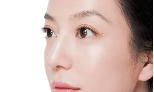 Nốt ruồi dưới mắt có khả năng liên quan đến sức khỏe