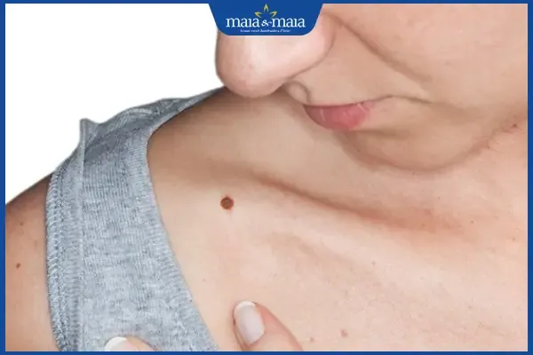 Tẩy nốt ruồi cần cân nhắc giữa thẩm mỹ, sức khỏe và phong thủy