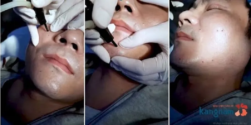 Quy trình tẩy nốt ruồi tại Kangnam được thực hiện theo tiêu chuẩn an toàn.