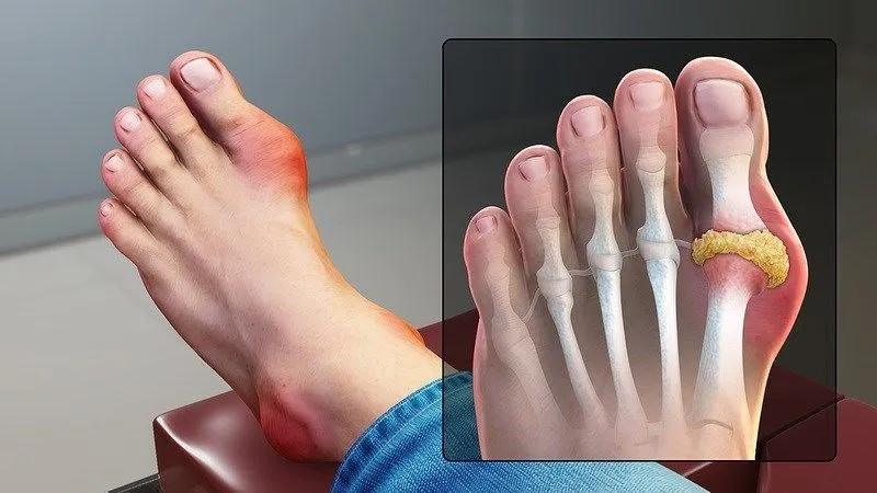 Người bị bệnh gout không nên ăn súp cua vì có thể làm tăng axit uric trong máu