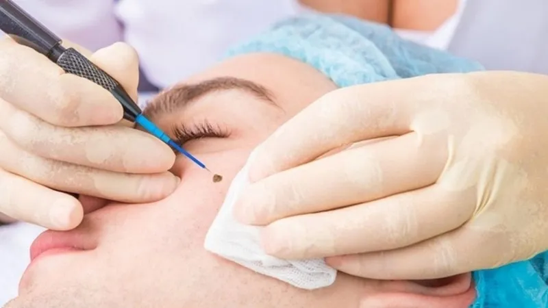 Chi phí tẩy nốt ruồi bằng tia laser tùy thuộc vào vị trí nốt ruồi