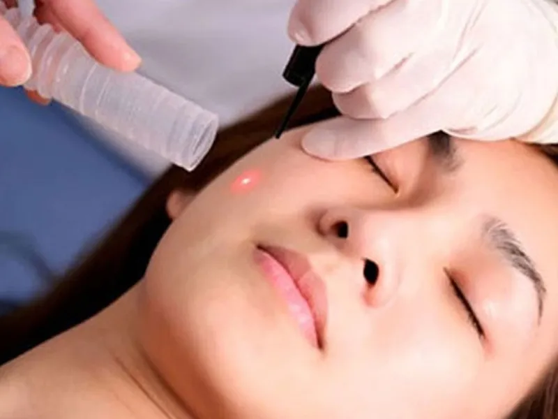 Tẩy nốt ruồi bằng laser không xâm lấn