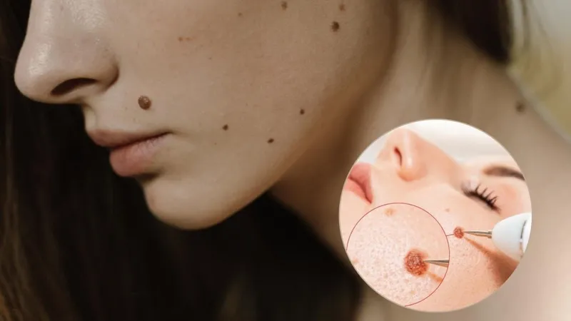 Chi phí tẩy nốt ruồi bằng tia laser tùy thuộc vào kích thước nốt ruồi