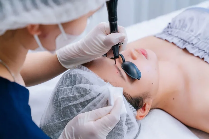 Tẩy nốt ruồi bằng laser chỉ tác động nhẹ trên bề mặt da