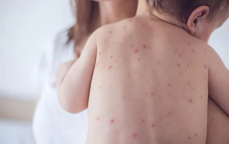 Sốt xuất huyết có thể khiến da nổi chấm đỏ như nốt ruồi son không ngứa