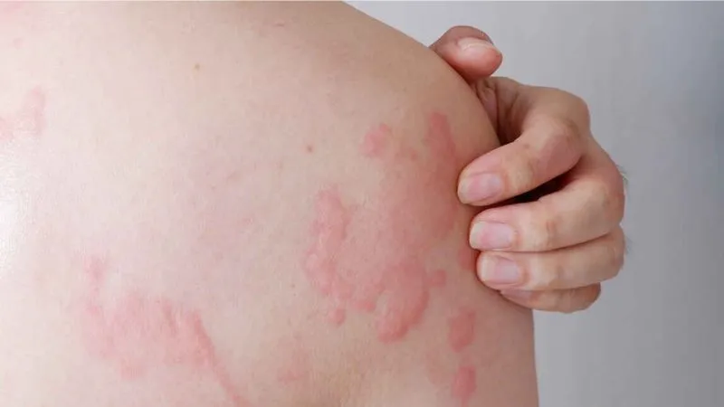 Ngừng ăn thanh long ngay khi phát hiện các dấu hiệu dị ứng như bừng đỏ mặt