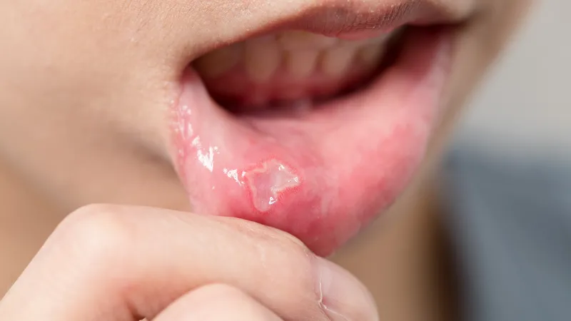 Người bị nhiệt miệng nên hạn chế dùng tía tô vì có thể khiến tình trạng trở nên trầm trọng hơn và gây cảm giác khó chịu