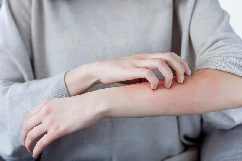 Người bị dị ứng với bồ công anh có thể xuất hiện các vết mẩn đỏ trên da