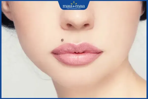 Người có nốt ruồi lệch ở nhân trung cần lưu ý gì