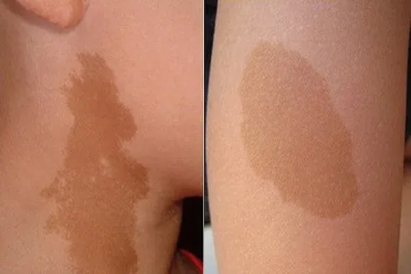 Vết bớt ở giữa lưng dự báo cuộc sống suôn sẻ và được quý nhân phù trợ