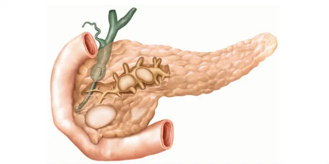 Viêm tụy là tình trạng tuyến tụy bị viêm